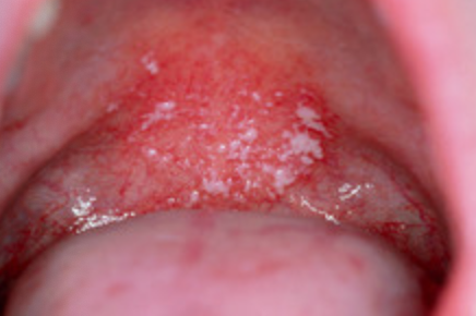 <p>1f. Which is the best first-line prescription therapy?</p>