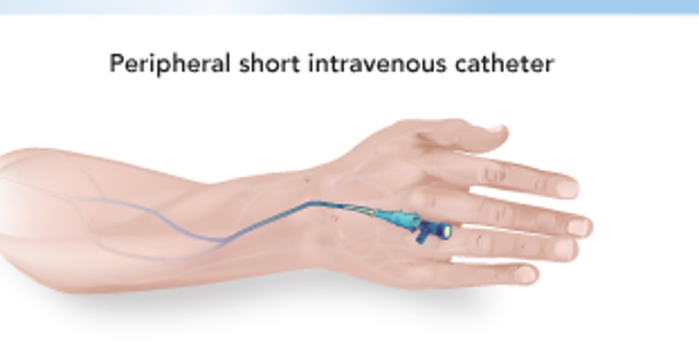 <p>Use: Medication, fluids, short-term use.</p><p>Location: Hand, arm.</p><p>PT Considerations: Avoid pulling; check for infiltration; typically doesn't restrict mobility.</p>