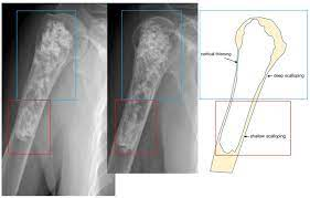 <p>a malignant tumor of cartilaginous origin that may originate anew or within a preexisting cartilaginous lesion Commonly occurs in long bones, but often originates in a rib, scapula, or vertebra. It is about half as common as osteogenic sarcoma. \n  It develops at a later age (peak incidence in 35-to-60-year-olds), grows more slowly, and metastasizes later.</p>