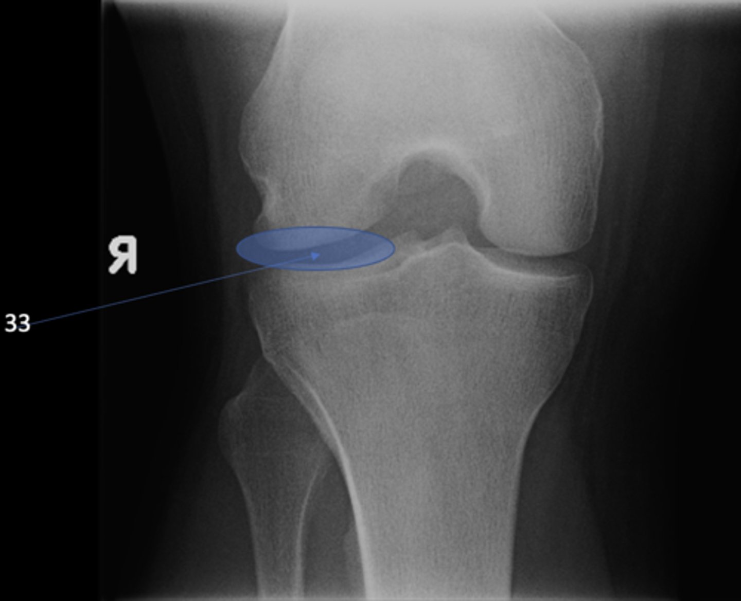 <p>ID 33 (joint)</p>