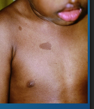 <p><strong>Cafe au Lait Macule</strong></p><p>-Usually present at birth or appear in early childhood, can be found anywhere on the body </p><p>-Flat, tan-brown _________ or patches (coffee with cream) that range from a few mm to > 15 cm. These can grow with the child </p><p>-Usually _______</p><p>-Can be associated with _________-__________ Syndrome, which has a _____, unilateral cafe au lait macule </p><p>-Can be associated with ______________ Type 1, which usually has > _ spots over 0.5 cm before puberty or 1.5 cm after puberty </p><p></p>