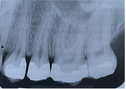 <p><span style="font-family: &quot;Times New Roman&quot;, serif">Which of the following conditions exists on this image?</span></p><ul><li><p><span style="font-family: &quot;Times New Roman&quot;, serif">a fixed bridge between the second premolar and second molar</span></p></li><li><p><span style="font-family: &quot;Times New Roman&quot;, serif">open contacts between maxillary premolars</span></p></li><li><p><span style="font-family: &quot;Times New Roman&quot;, serif">open contacts between the molars&nbsp;</span></p></li><li><p><span style="font-family: &quot;Times New Roman&quot;, serif">pulp stone on the second molar</span></p></li></ul><p></p>