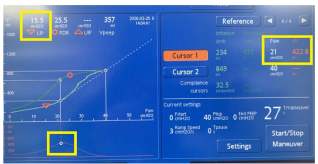 DV graph shows what vol change was during maneuver --> highest C yields highest vol change --> so put cursor on highest point of graph --> correlates to LIP --> optimal PEEP

^^proof that LIP yielded highest C