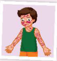 <p>bệnh thủy đậu</p>