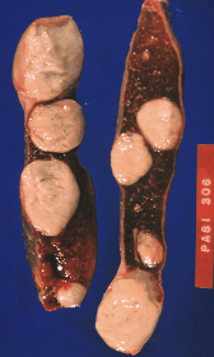 <p>Classify this lesion:</p><p>Cyst</p><p>Abscess</p><p>Polyp</p><p>Ulcer</p>