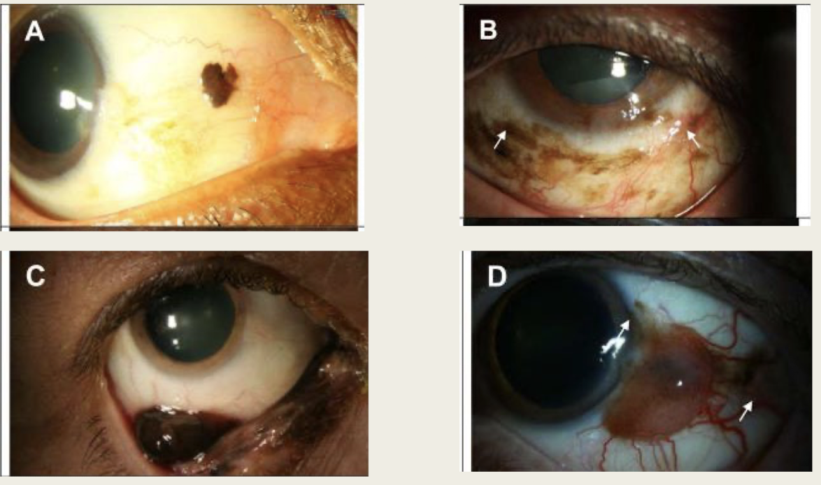 <p>pigmented elevated lesion</p><p>surrounding pigmentation</p><p>enlarged feeder vessels</p>