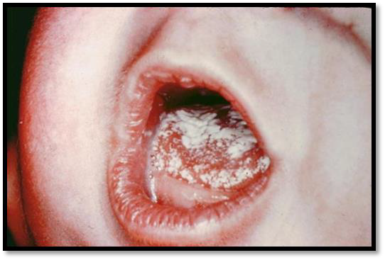 <p>is a medical condition in which a yeast-like fungus called Candida albicans overgrows in the mouth and throat.</p><p>It is part of the normal flora; overgrows if patient is on long term antibioticsor ill-fitting denture</p>