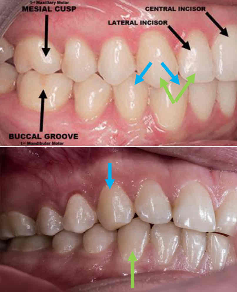 <p>which teeth does the mandibular canine occludes with?</p>