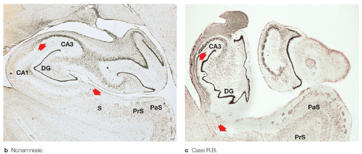 <p>• seemingly intact hippocampi </p>
<p>• but selective lesions to CA1 region of hippocampi with CA1 pyramidal cells</p>