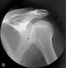 <p>name the projection and rotational; label the part of the humerus the arrow is pointing to </p>