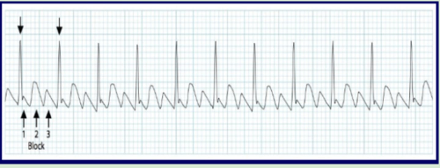<p>Originate: atrial automaticity focus in self-perpetuating loop</p><p>QRS complex: narrow</p><p>P wave: saw tooth pattern</p><p>Heart rate: 250-400 bpm</p><p>R-R intervals: regular</p>