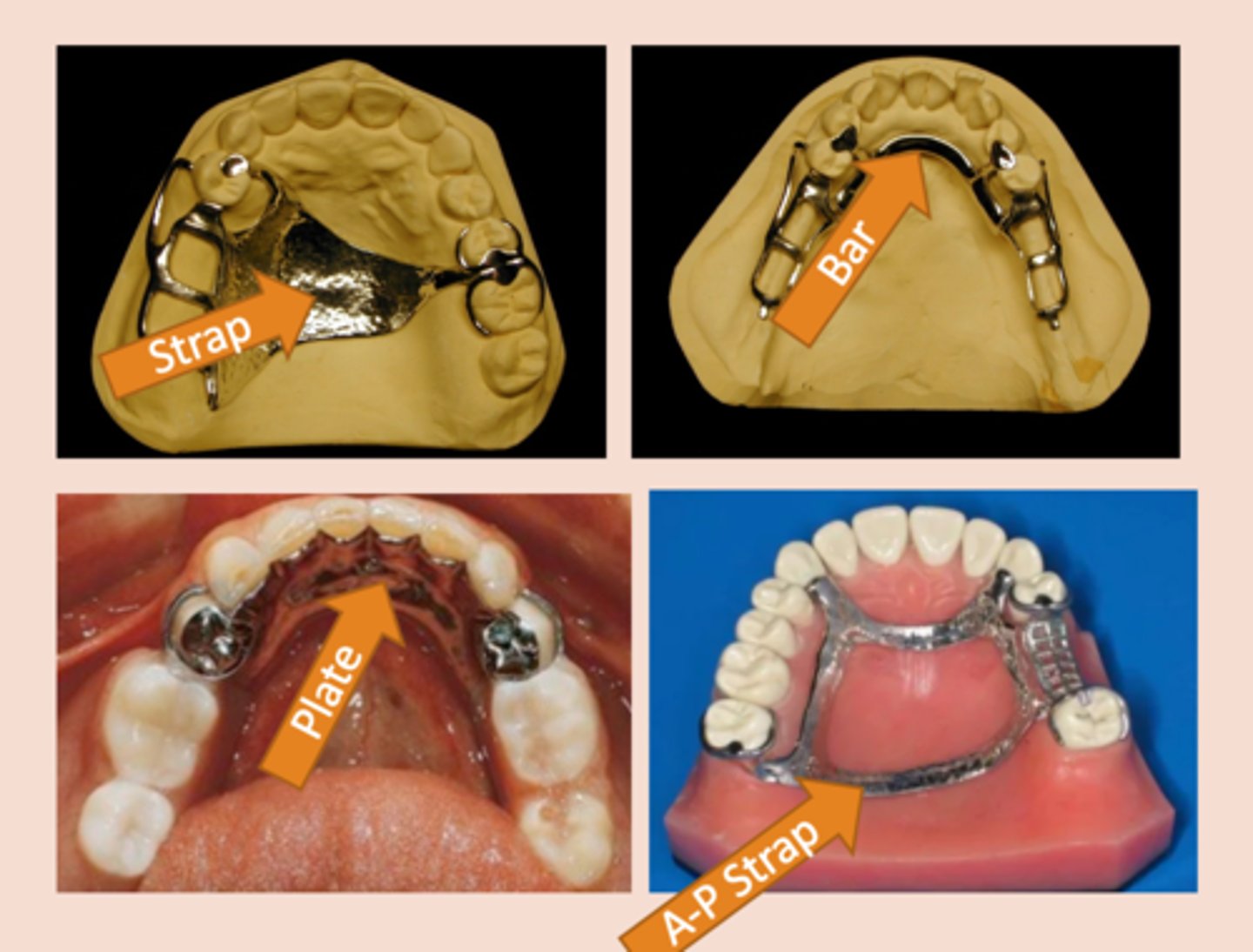 <p>The part of the removable partial denture that joins the components on one side of the arch to those on the opposite side, Aid in cross arch stabilization, transmitting functional loads from one side of the arch to the other</p>