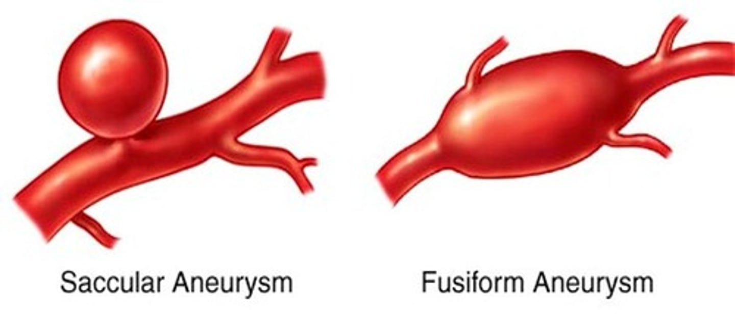 <p>when arteries branch, blood hitting fork point causes it to balloon out and distend with blood. Common in circle of Willis. Causes gradual degeneration of internal elastic lamina and tunica media which eventually ruptures. Can grow to 6-7mm</p>
