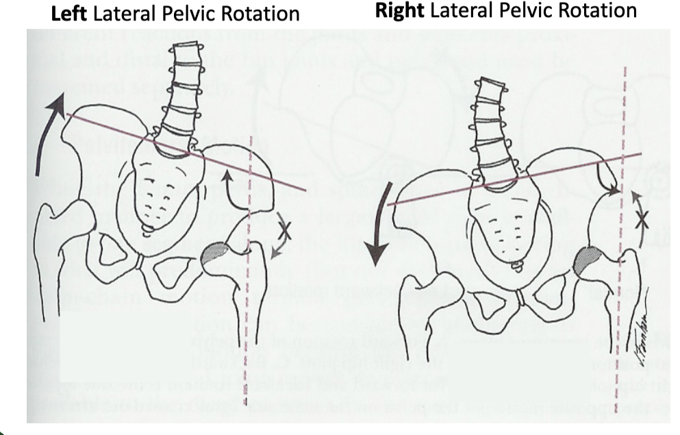 <p>in frontal plane right pelvis moves inferiorly in relation to left pelvis; either right pelvis rotates downward or left pelvis rotates upward; right lateral tilt</p>