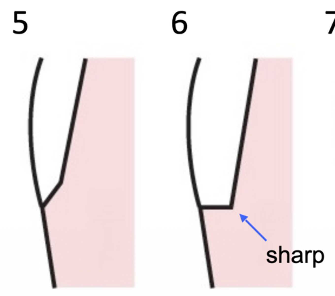 <p>What type of margin design is at 5?</p>