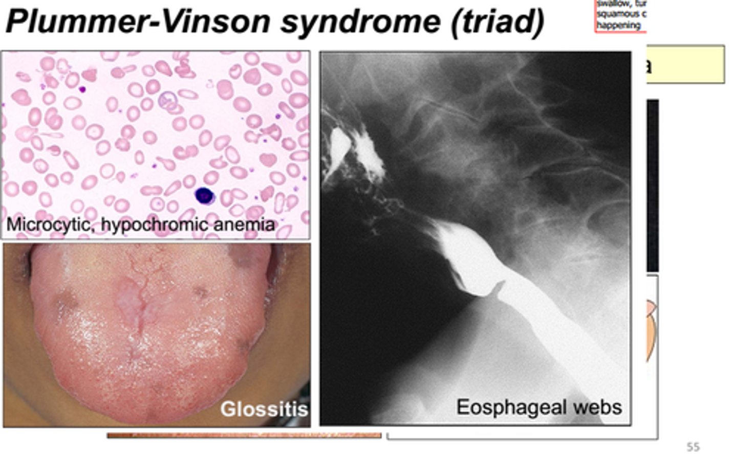 <p>Plummer-Vinson syndrome</p><p>(may progress to esophageal squamous cell carcinoma)</p>
