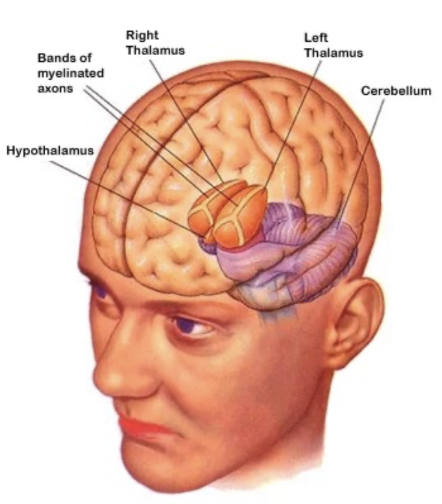 <p>→ part of the <strong>forebrain</strong>; structure sandwiching the <strong>hypothalamus</strong></p><ul><li><p>Bilateral structure made up of several nuclei that relay ascending sensory information to different regions of the <strong>cerebrum</strong></p><ul><li><p><strong>Lateral geniculate nuclei (LGN)</strong> → transmits visual info</p></li><li><p><strong>Media geniculate nuclei (MGN)</strong> → transmits auditory info</p></li></ul></li></ul><p></p>