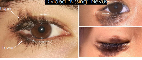 <p>Develops before embryologic separation of eyelids, divides when eyelids separate</p>