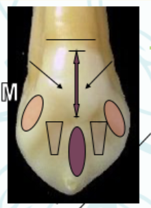 <p><mark data-color="green" style="background-color: green; color: inherit">maxillary canines #6 and #11; lingual view</mark></p>