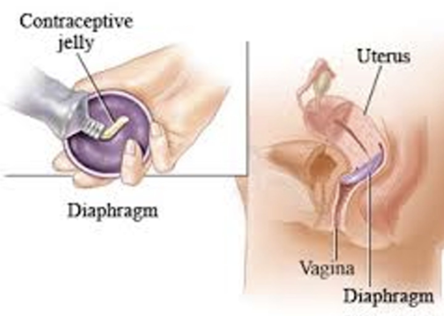 <p>Barrier method requiring prescription and fitting.</p>