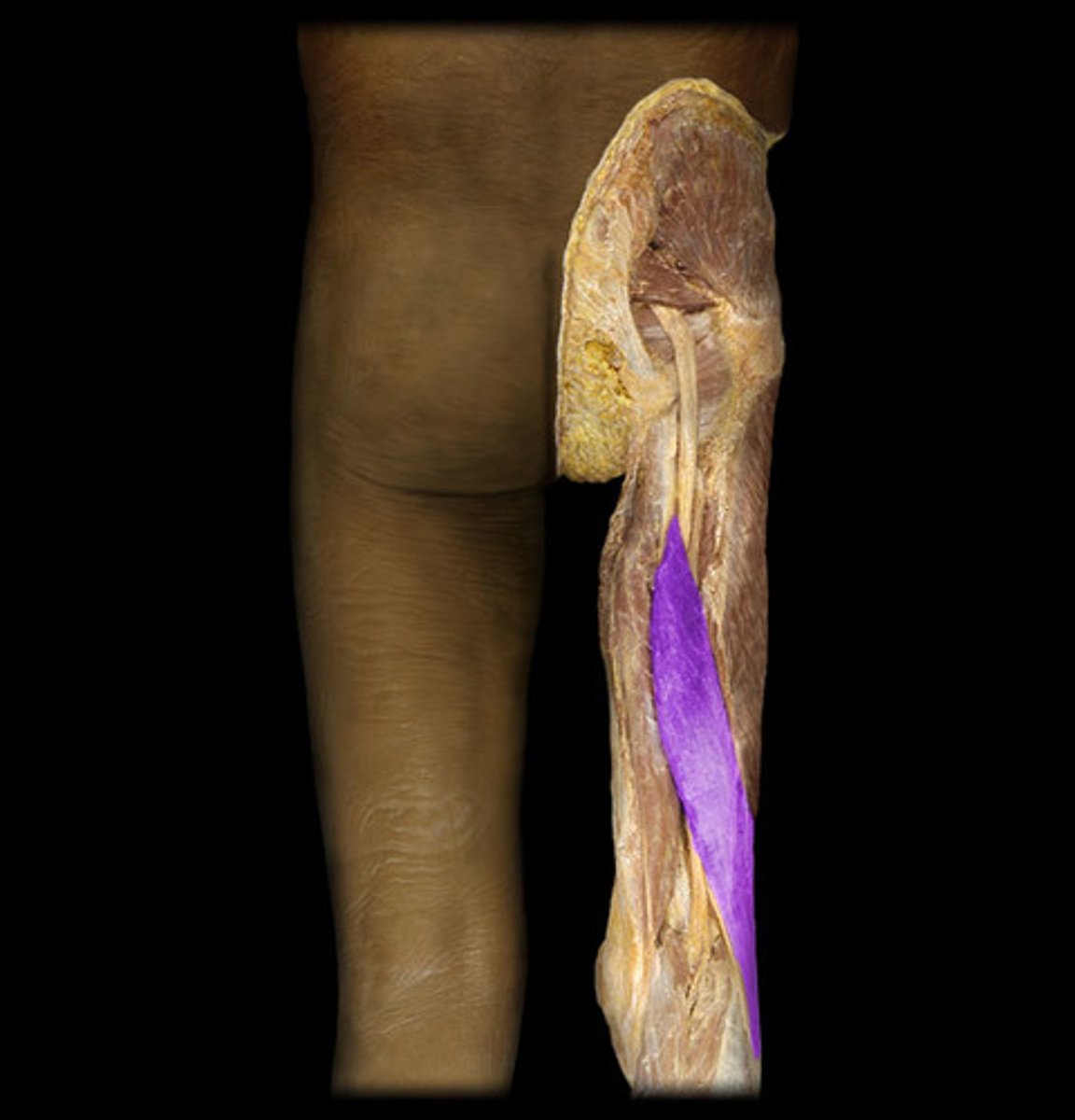 <p>Proximal attachment: (long head) ischial tuberosity, (short head) femur (linea aspera)</p><p>Distal attachment: Head of the fibula</p><p>Comments, Applications and Relationships: "Boys" of BTM acronym. Helpful hint- can be identified by the muscle splitting into 2 distinct (bipennate) heads, long and short.</p><p>Action: Flexor of the leg at the knee</p>