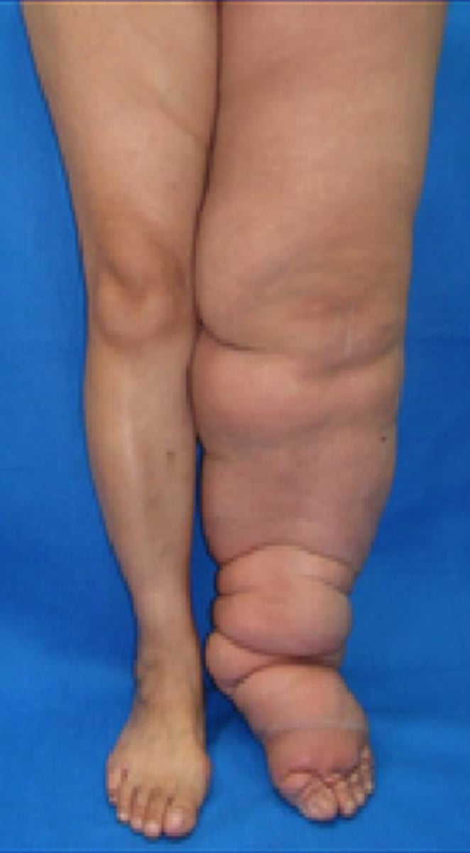 <p>&gt;5 cm difference between affected and unaffected limbs</p>