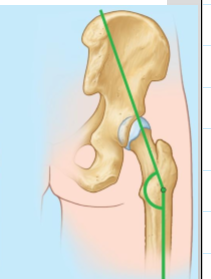 <p>Femoral neck–shaft (CCD) angle &gt; 135° </p>