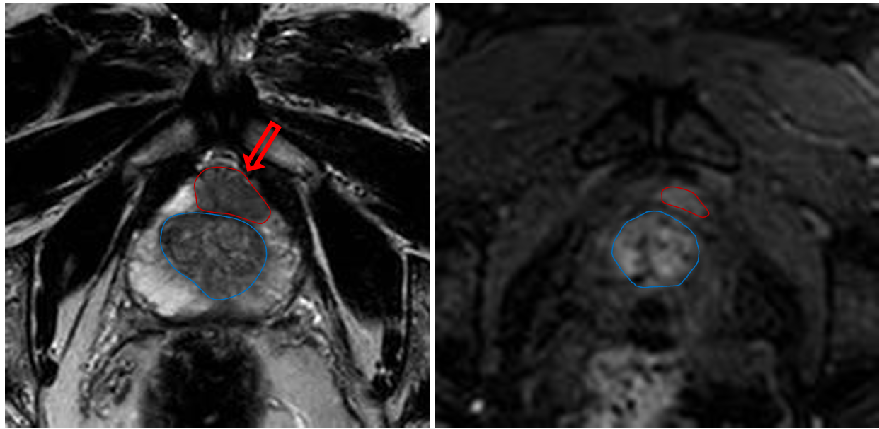<p>Patient history: elevated PSA level and positive transrectal ultrasonography study in an elderly patient </p><p>Modality : T2W MRI and dynamic contrast-enhanced MRI of the prostate after iv. gadolinium contrast agent administration </p><p>Region : pelvis, axial views </p><p>Radiologic sign: T2 hypointensity in the peripheral zone (left panel); intensive contrast-enhancing mass in the same area (signed with red); normal transitional zone (signed with blue) </p><p>Diagnosis: prostate adenocarcinoma</p>