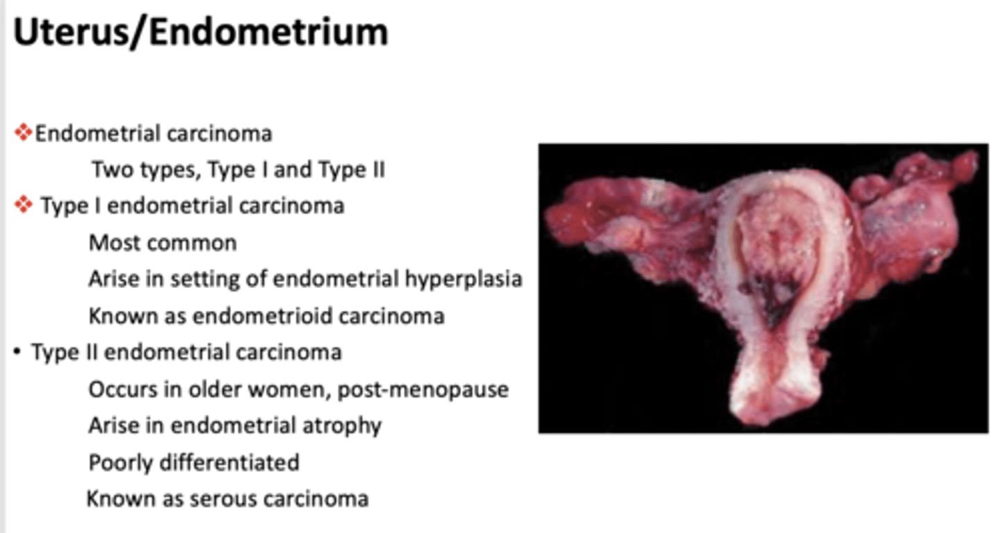 <p>Type I endometrial carcinoma</p>