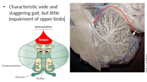 <p>degeneration of the anterior portion of the spinocerebellum which is crucial for lower limb activity therefore they have a&nbsp;wide and staggering gait, but little impairment of upper limbs</p>