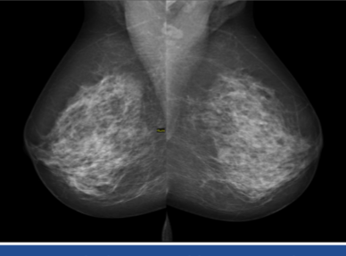 <p>radiographic technique used to screen for breast cancer</p><p>can reveal cancer before even palpable</p>