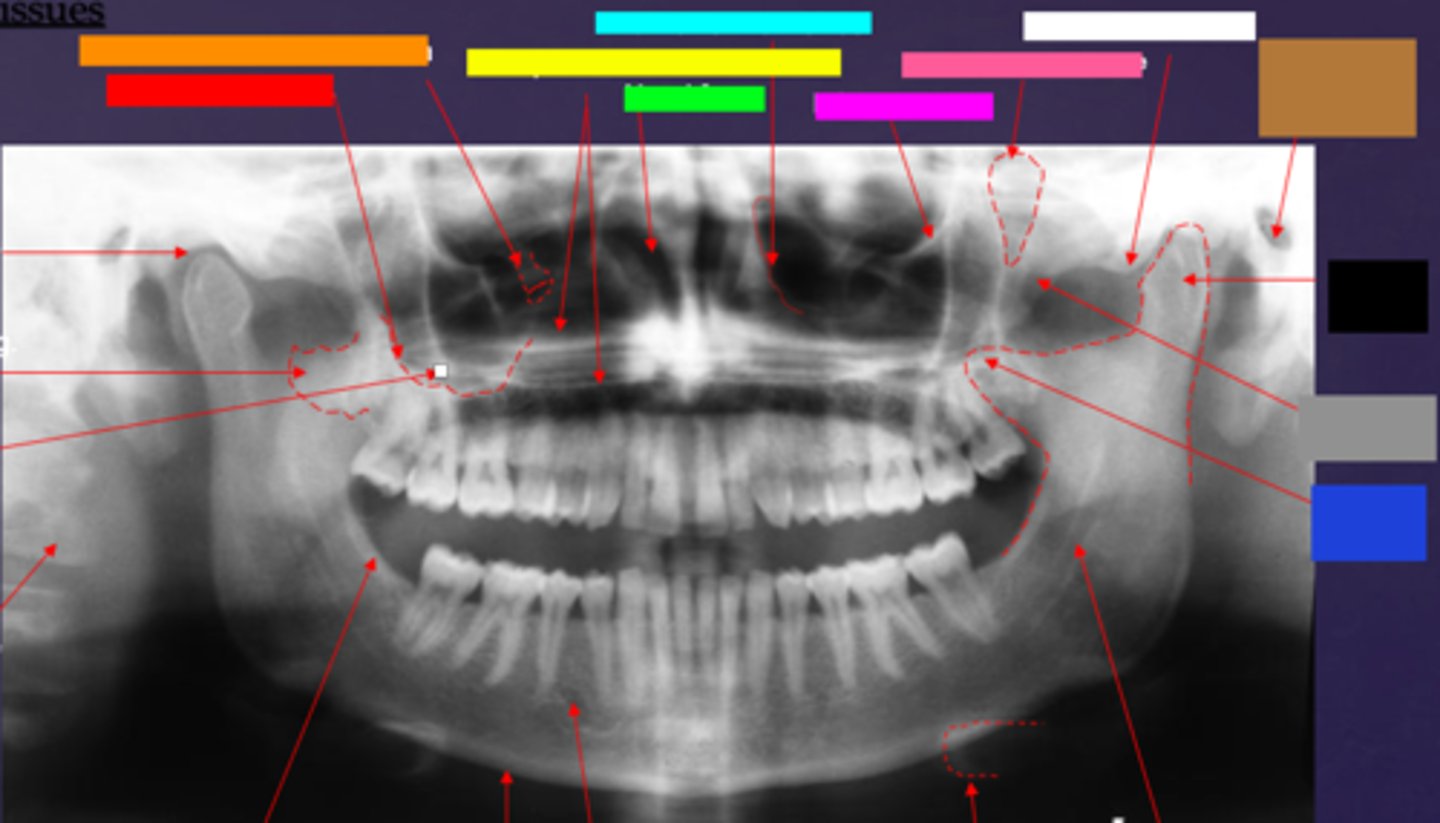<p>ID the hard tissue anatomy indicated by the arrow pointing from the dark blue box:</p>