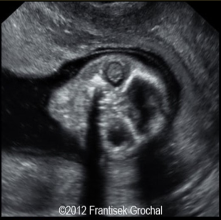 <p>in the 2nd trimester, documenting a normal lens in each eye on the fetal US can rule out </p><p>a) arhinia</p><p>b) holoprosencephaly</p><p>c) stigmatism</p><p>d) cataracts</p>
