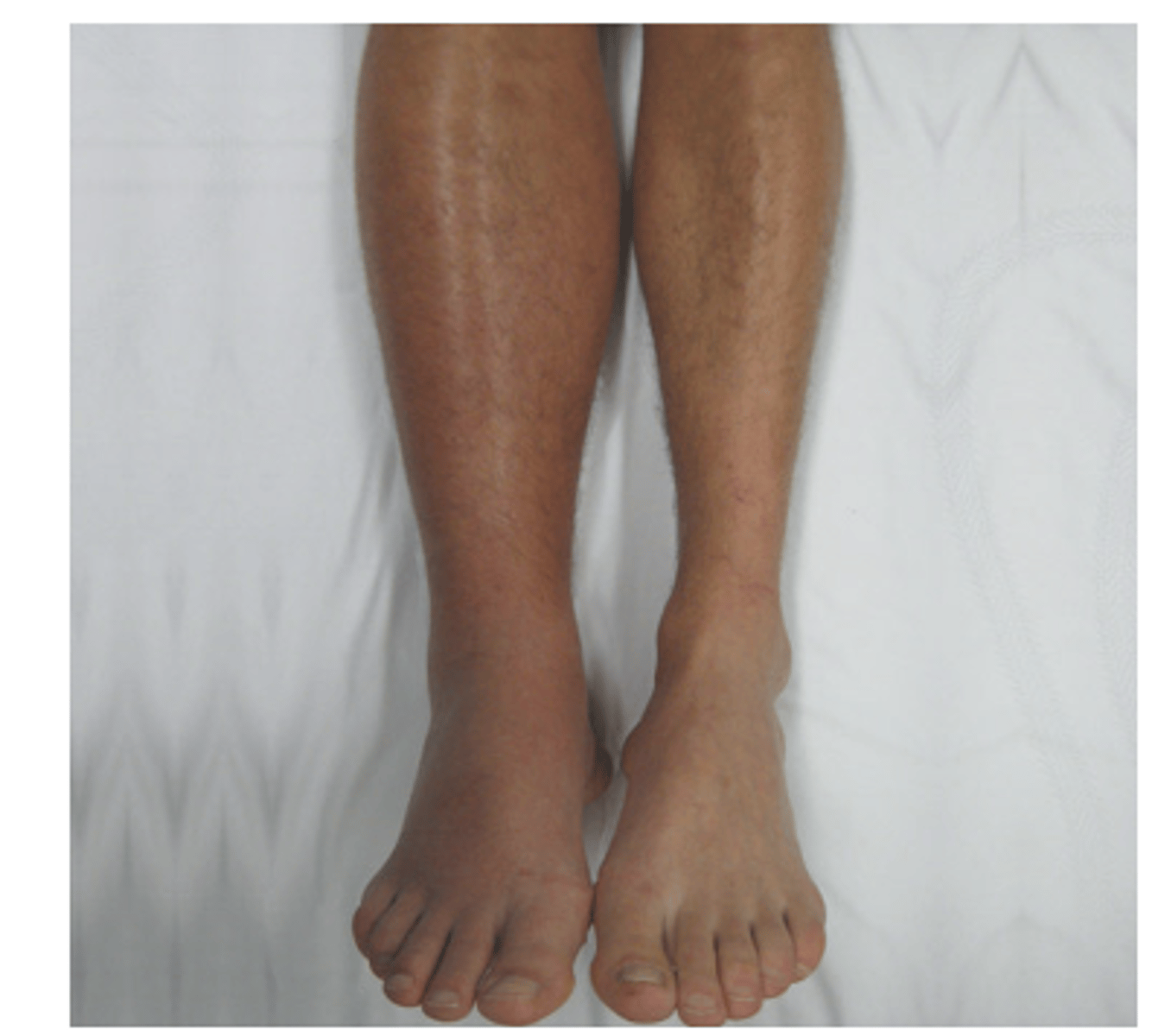 <p>-Pain</p><p>-Heaviness</p><p>-Functional impairment</p><p>-Ankle engorgement</p><p>-Edema</p><p>-Increase temperature in leg</p><p>-Tenderness</p><p>-HOMANS SIGN IS NOT A RELIABLE SIGN FOR DVT</p>