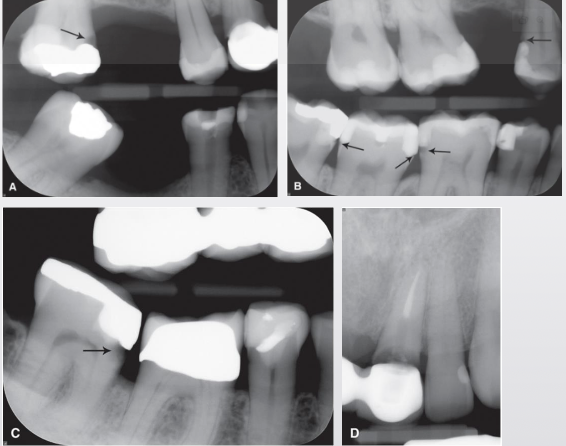 <p>What are recurrent (secondary) caries?</p>