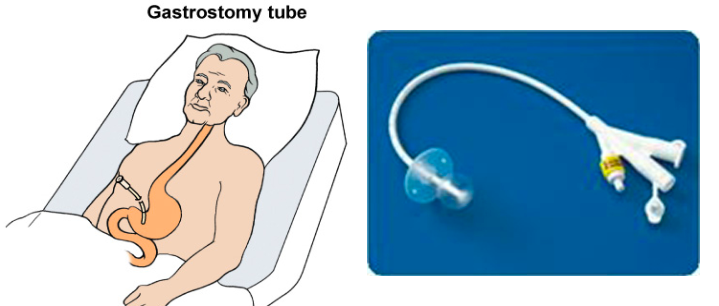 <p>directly into stomach. surgically placed</p><p>balloon inside stomach helps it to stay in place </p><p>peg (percutaneous endoscopic gastronomy): inserted via mouth</p>