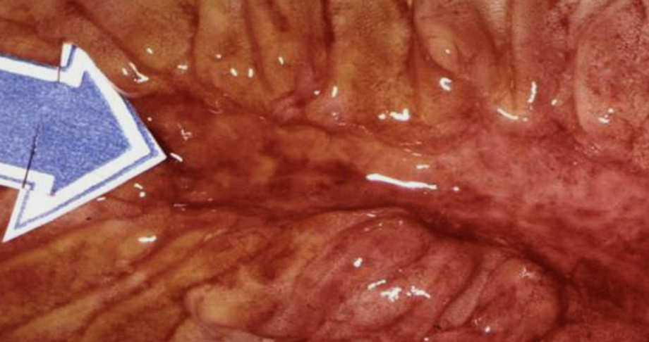 <p>Inflammation involving mucosal surfaces (stomach, intestine, etc) leading to epithelial loss and ulcer formation.</p>