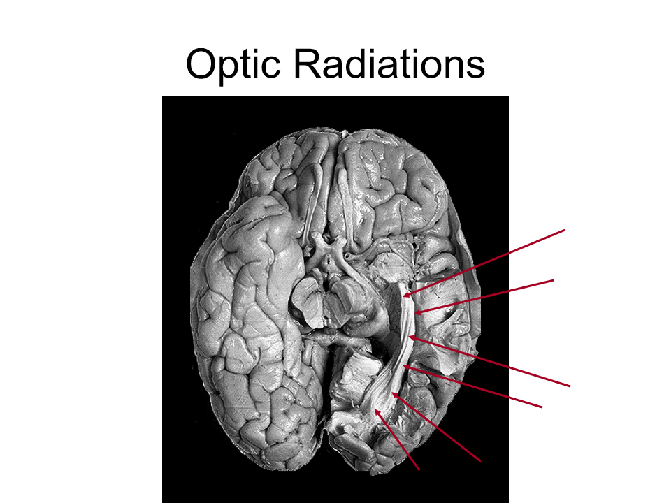 <p>group of axons that are organized and travel back to primary visual cortex</p>