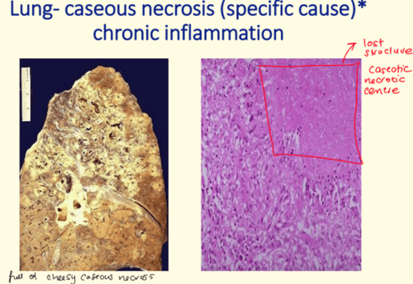 <p>Caseous necrosis of the lung </p>