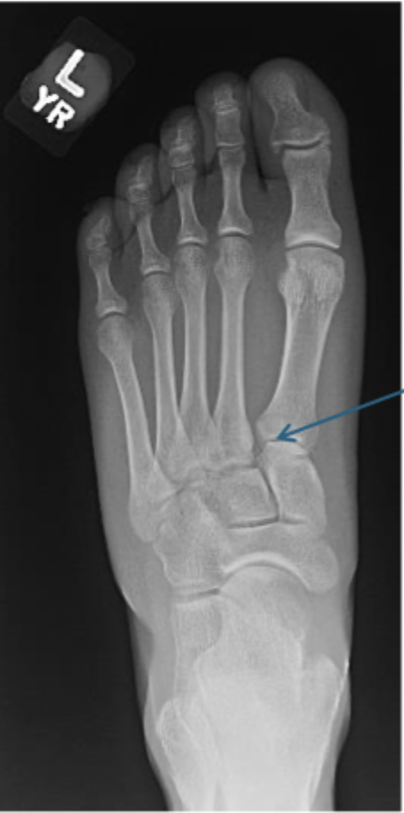 <p>How might a “subtle” lisfranc fracture look</p>
