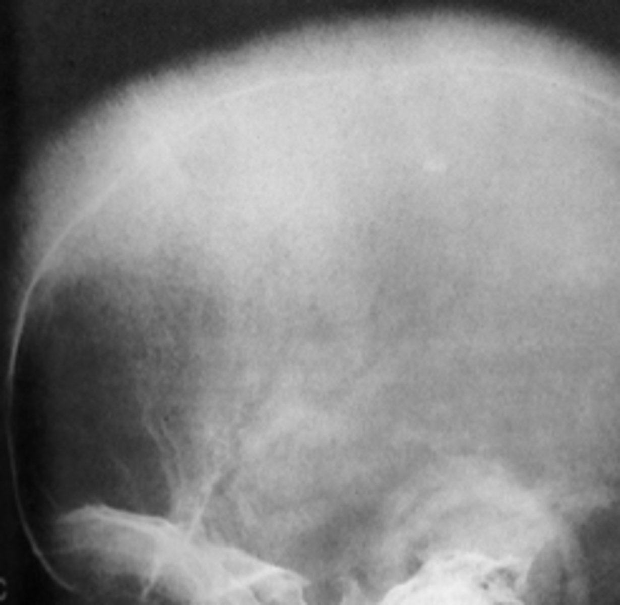 <p>Patient's radiograph shows:</p><p>- Hair-on-end appearance of outer table</p><p>- Generalized osteoporosis</p><p>- Fewer and coarser trabeculae</p><p>- Large marrow spaces</p><p>What is the diagnosis?</p>