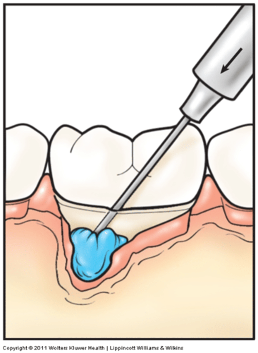 <p>through controlled release delivery device</p>