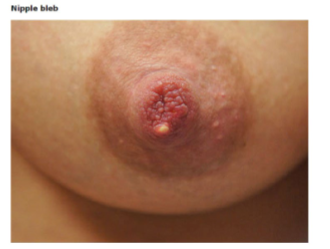 <p><strong>Ductal Narrowing</strong></p><p>-Localized duct narrowing → commonly called __________ milk ducts </p><ul><li><p>A tender and often __________ palpable lump due to obstruction of a mammary duct </p></li><li><p>Obstruction of the nipple pore ducts may also occur and present as a _____ bleb at the end of the nipple, “milk blister” </p></li></ul><p>-Management → optimize ________ technique, cool compresses, manual _________, Ibuprofen and acetaminophen, and topical 0.1% ____________ cream for nipple blebs to reduce inflammation</p><p></p>