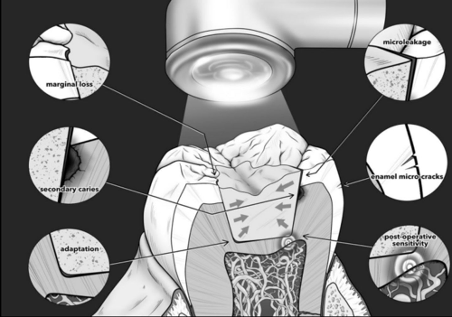 <p>Creation of internal stress</p><p>Cusp deformation</p><p>Marginal gaps</p><p>Enamel cracks</p><p>- marginal leakage</p><p>- postoperative sensitivity</p><p>- secondary caries</p>