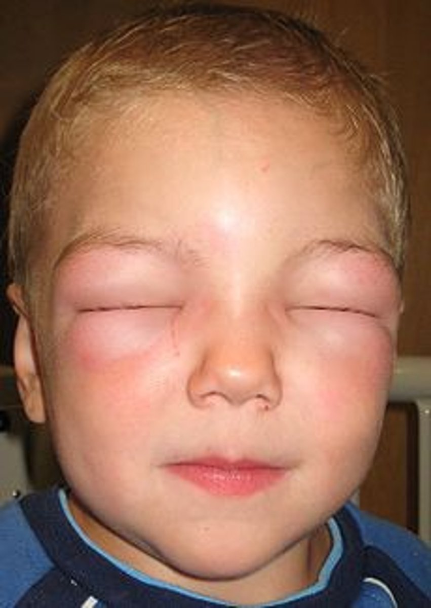 <p>-histologically deeper variant of urticaria - dermal and subcutaneous swelling</p><p>-more diffuse swelling, less pruritus than urticaria</p><p>-Mc affected areas include lips, palms, soles, limbs, trunk, and genitals</p><p>-rarely, angioedema of the throat, tongue, or lungs can block airway</p>