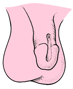 <p>= abnormality where the meatus is located dorsal</p>