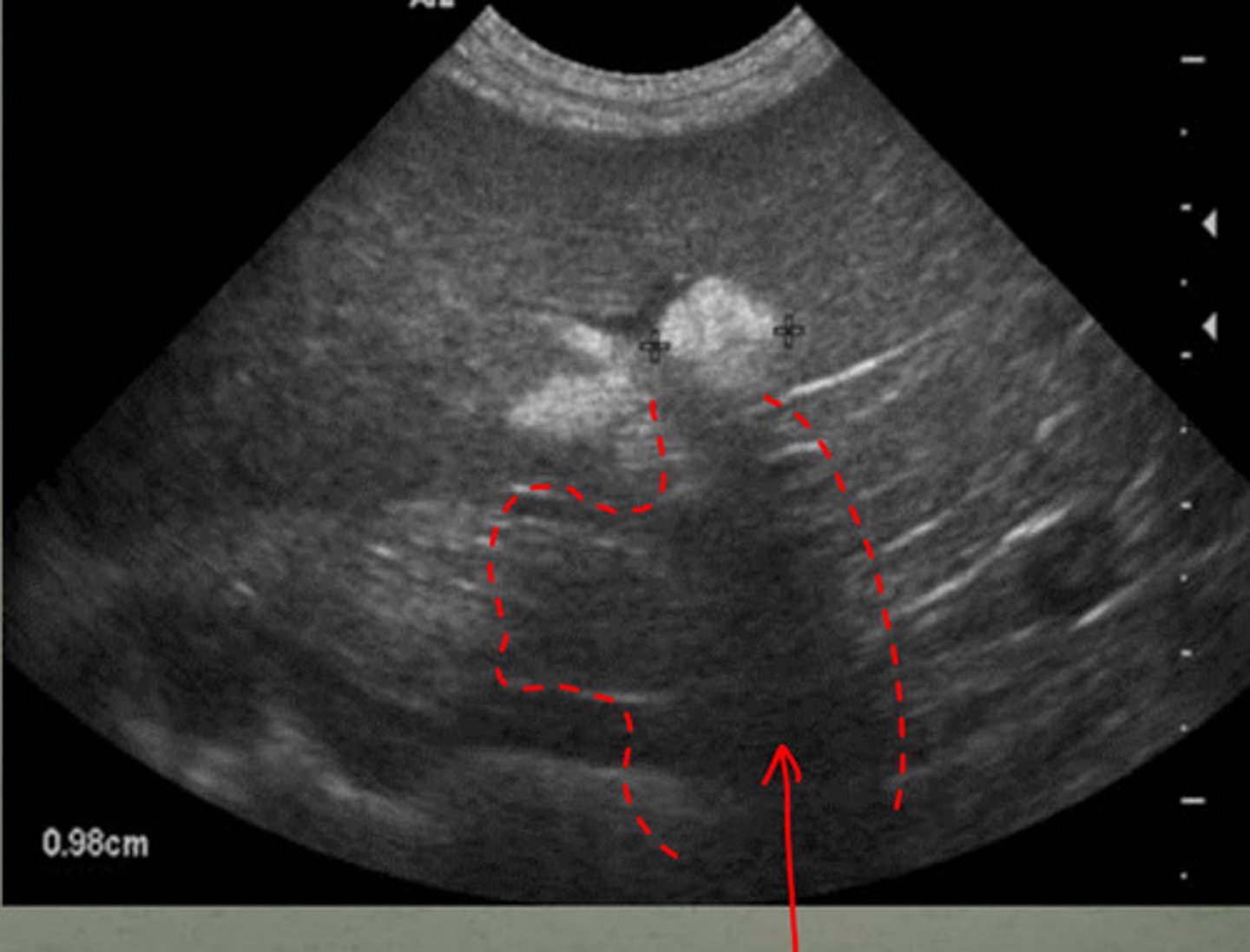 <p>is this shadowing near the spleen normal?</p>