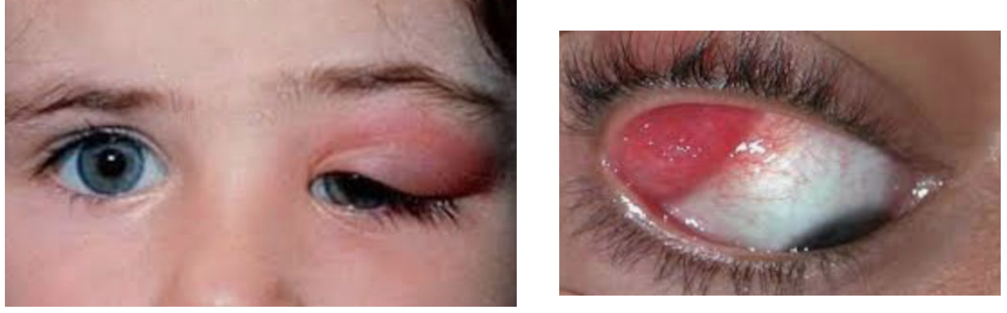 <p>What is the clinical term for inflammation of the lacrimal gland?</p>