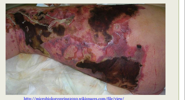 What infection is this ?