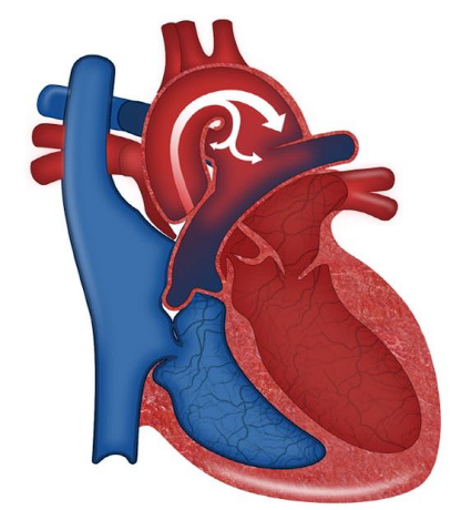 __**● Defect**__  

○ Failure of the ductus arteriosus to close 

○ Should close 12 to 72 hours after birth  

__**● Specific assessment findings**__  

○ Machine-like murmur 

__**● Treatment:**__  

○ Small: often close spontaneously  

○ Indomethacin or ibuprofen  

○ Surgically closed  

__**● Alprostadil (Prostaglandins/PGE)**__ 

○ Medication that can be administered to keep the PDA open in certain heart  defects.  

○ This can allow blood to get out to the body when it otherwise couldn’t. 